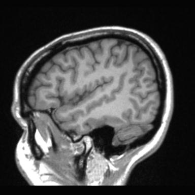 File:Atretic encephalocoele with inferior vermis hypoplasia (Radiopaedia 30443-31108 Sagittal T1 23).jpg