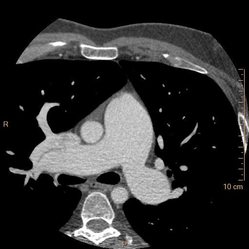Atrial septal defect (upper sinus venosus type) with partial anomalous pulmonary venous return into superior vena cava (Radiopaedia 73228-83961 A 58).jpg
