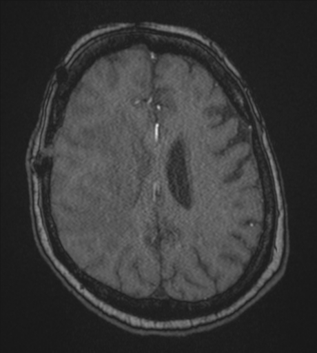 Atypical meningioma (WHO Grade II) (Radiopaedia 54742-60981 Axial MRA 68).png
