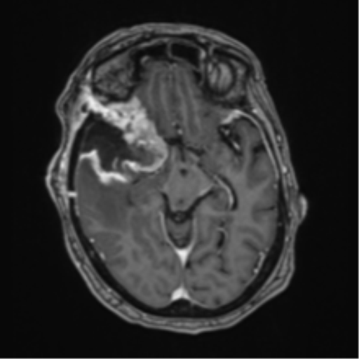 Atypical meningioma (WHO Grade II) (Radiopaedia 54742-60981 Axial T1 C+ 29).png