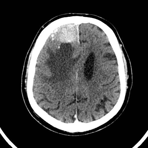 File:Atypical meningioma (WHO grade II) with brain invasion (Radiopaedia 57767-64728 Axial C+ 18).png