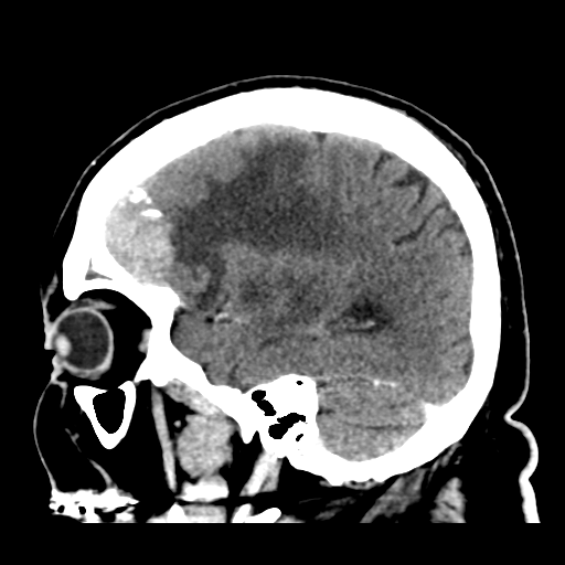 Atypical meningioma (WHO grade II) with brain invasion (Radiopaedia 57767-64728 Sagittal C+ 14).png