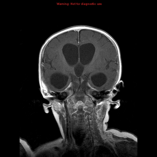 File:Atypical teratoid rhabdoid tumor (Radiopaedia 10712-11183 Coronal T1 C+ 11).jpg