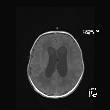 Atypical teratoid rhabdoid tumor (prenatal US and neonatal MRI) (Radiopaedia 59091-66388 Axial T1 39).jpg