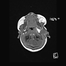 Atypical teratoid rhabdoid tumor (prenatal US and neonatal MRI) (Radiopaedia 59091-66388 Axial T1 8).jpg