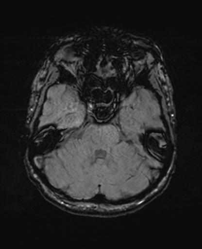 Autoimmune limbic encephalitis (Radiopaedia 30363-31005 SWI 23).jpg