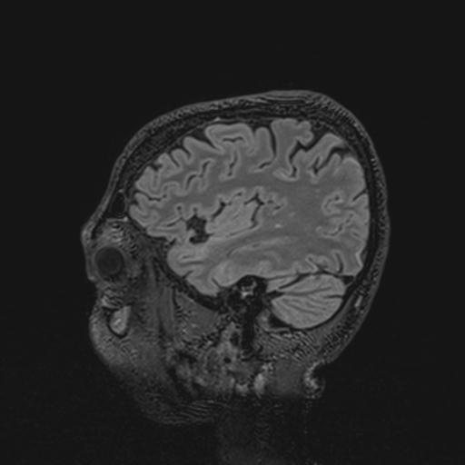 Autoimmune limbic encephalitis (Radiopaedia 30363-31005 Sagittal FLAIR 118).jpg