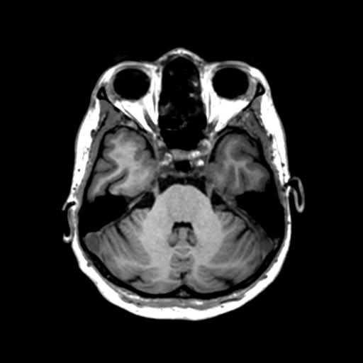 Autoimmune limbic encephalitis (Radiopaedia 30363-31005 T1 Axial 1mm 47).jpg