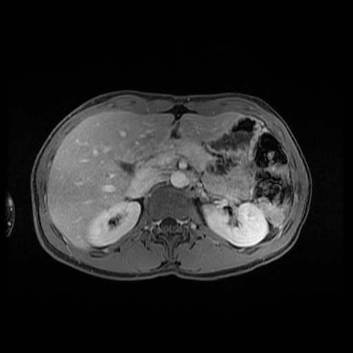 Autoimmune pancreatitis (Radiopaedia 69751-79729 Axial T1 C+ fat sat 57).jpg