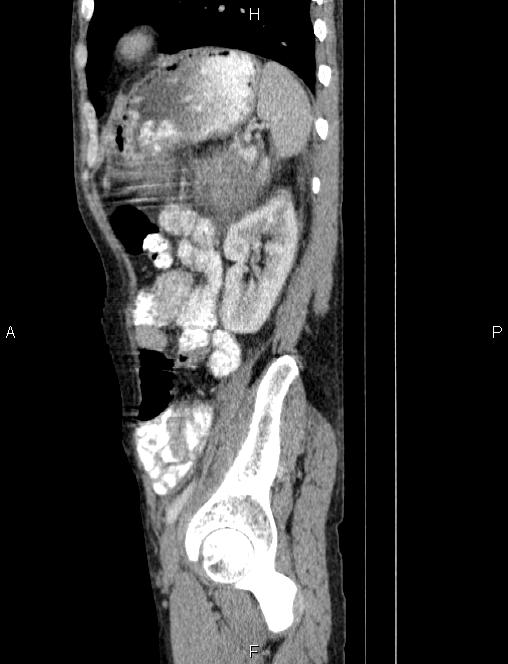 Autoimmune pancreatitis (Radiopaedia 84925-100431 E 73).jpg