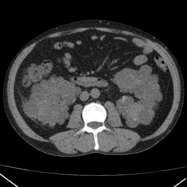 File:Autosomal dominant polycystic kidney disease (Radiopaedia 36539-38101 Axial non-contrast 42).jpg