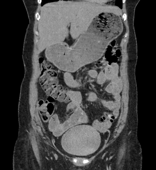 Autosomal dominant polycystic kidney disease (Radiopaedia 38189-40194 Coronal C+ delayed 15).jpg
