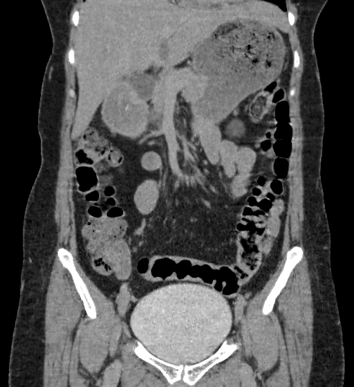 Autosomal dominant polycystic kidney disease (Radiopaedia 38189-40194 Coronal C+ delayed 28).jpg