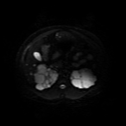 Autosomal dominant polycystic kidney disease (Radiopaedia 50259-55611 Axial DWI 19).jpg