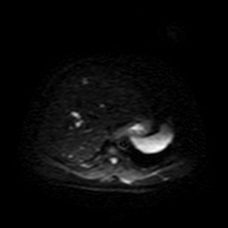 Autosomal dominant polycystic kidney disease (Radiopaedia 50259-55611 Axial DWI 8).jpg