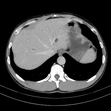 Autosomal dominant polycystic kidney disease (Radiopaedia 66349-75582 B 11).jpg