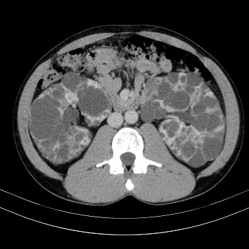 Autosomal dominant polycystic kidney disease (Radiopaedia 66349-75582 B 46).jpg