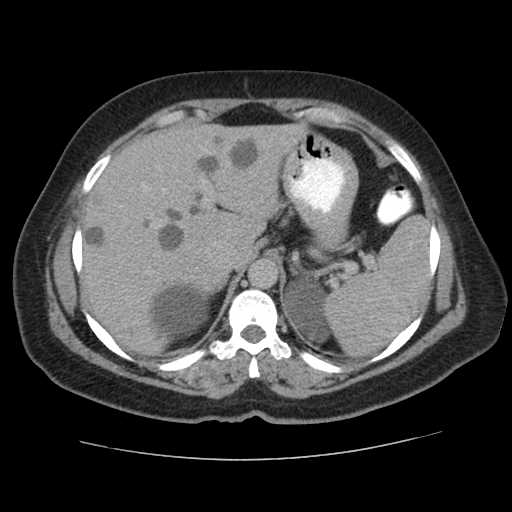 Autosomal dominant polycystic kidney disease with hepatic involvement (Radiopaedia 32693-33662 C 15).jpg