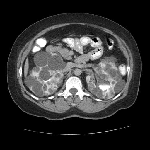 File:Autosomal dominant polycystic kidney disease with hepatic involvement (Radiopaedia 32693-33662 C 30).jpg