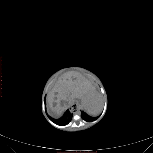 File:Autosomal recessive polycystic kidney disease associated with Caroli disease (Radiopaedia 61932-69984 Axial non-contrast 107).jpg