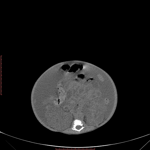 Autosomal recessive polycystic kidney disease associated with Caroli disease (Radiopaedia 61932-69984 Axial non-contrast 218).jpg