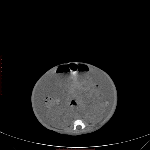 Autosomal recessive polycystic kidney disease associated with Caroli disease (Radiopaedia 61932-69984 Axial non-contrast 234).jpg