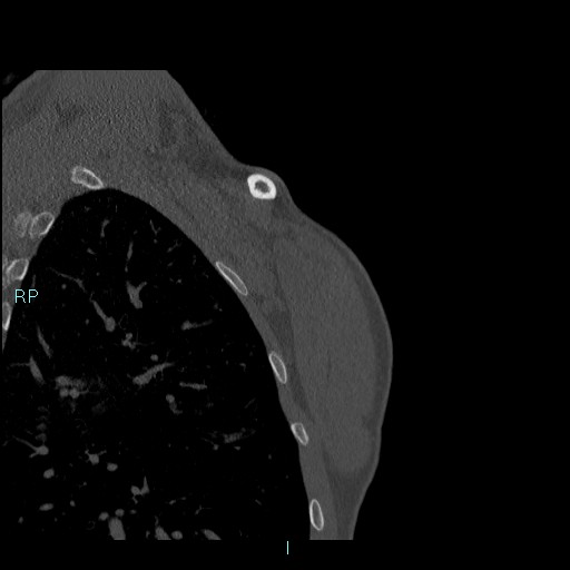 Avascular necrosis after fracture dislocations of the proximal humerus (Radiopaedia 88078-104655 Coronal bone window 137).jpg