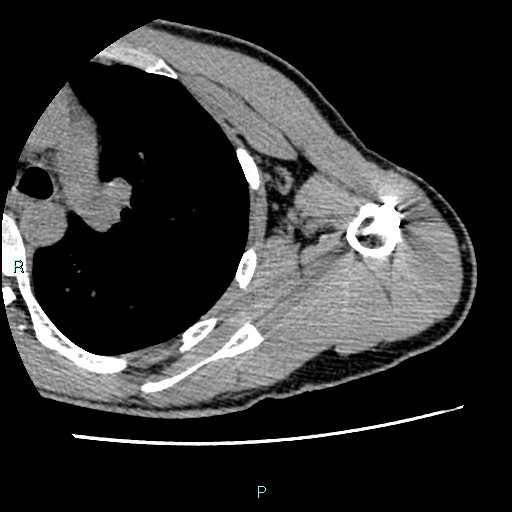 File:Avascular necrosis after fracture dislocations of the proximal humerus (Radiopaedia 88078-104655 D 74).jpg