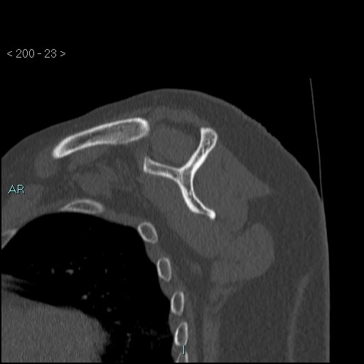 Avascular necrosis of the shoulder - Cruess stage I (Radiopaedia 77674-89887 Sagittal bone window 22).jpg