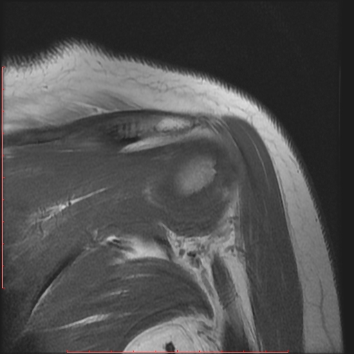 File:Avulsion fracture - greater tuberosity of humerus (Radiopaedia 25457-25703 Coronal T1 11).jpg