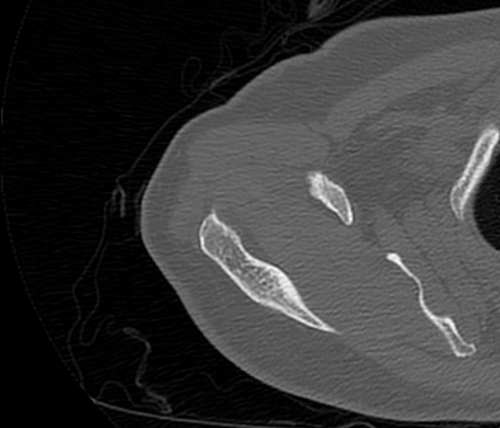 Avulsion fracture - greater tuberosity of humerus (Radiopaedia 71216-81514 Axial bone window 19).jpg