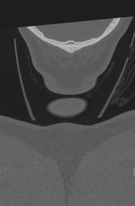 Axis peg fracture (type 3) and atlas lateral mass (type 4) fracture (Radiopaedia 37474-39324 Coronal bone window 77).png