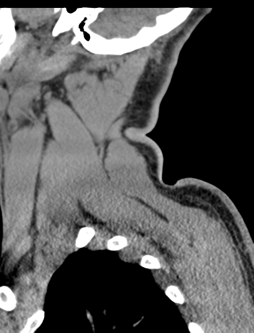 Axis peg fracture (type 3) and atlas lateral mass (type 4) fracture (Radiopaedia 37474-39324 D 4).png