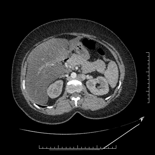 File:Azygos continuation of the IVC (Radiopaedia 40416-42965 A 28).jpg