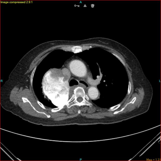Azygos vein aneurysm (Radiopaedia 77824-90130 B 24).jpg