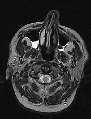 File:Balo concentric sclerosis (Radiopaedia 50458-55940 Axial T2 45).jpg