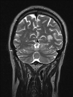 Balo concentric sclerosis (Radiopaedia 50458-55940 Coronal T2 42).jpg