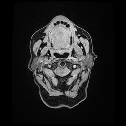 Balo concentric sclerosis (Radiopaedia 53875-59982 Axial LAVA C+ 3).jpg