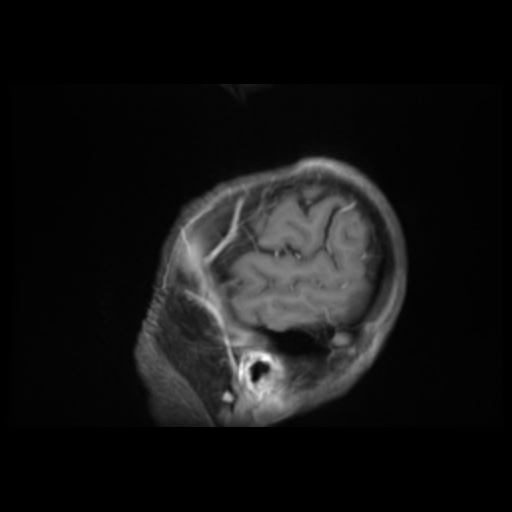 File:Balo concentric sclerosis (Radiopaedia 53875-59982 Sagittal LAVA C+ 39).jpg