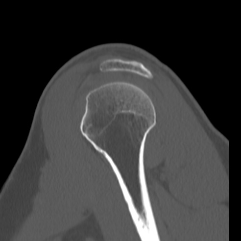 Bankart lesion (Radiopaedia 57256-64185 Sagittal bone window 18).jpg