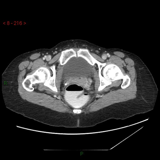 Bartholin gland cyst (Radiopaedia 54904-61181 A 54).jpg