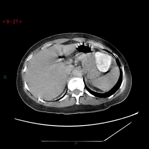 File:Bartholin gland cyst (Radiopaedia 54904-61181 Axial C+ delayed 7).jpg