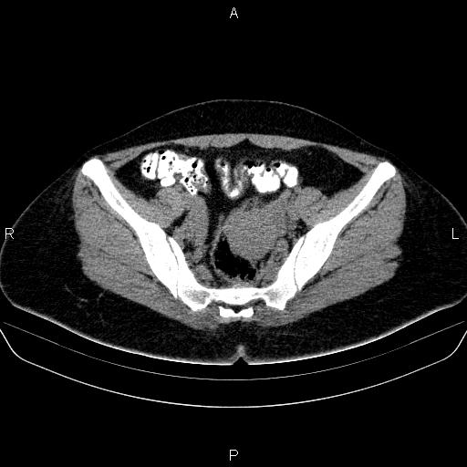 Bartholin gland cyst (Radiopaedia 62635-70930 Axial non-contrast 35).jpg
