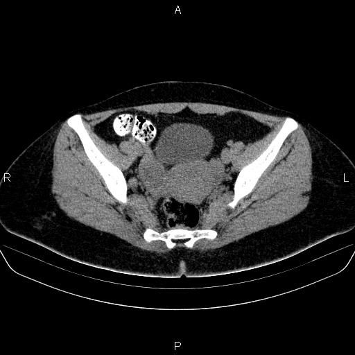 Bartholin gland cyst (Radiopaedia 62635-70930 Axial non-contrast 41).jpg
