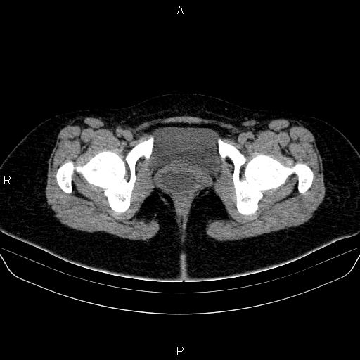 Bartholin gland cyst (Radiopaedia 62635-70930 Axial non-contrast 74).jpg
