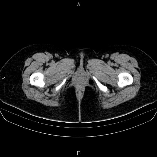 Bartholin gland cyst (Radiopaedia 62635-70930 Axial non-contrast 97).jpg