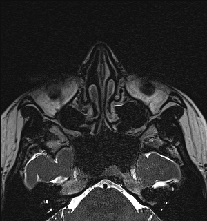 File:Basal cell carcinoma - nasal region (Radiopaedia 70292-80365 Axial Gradient Echo 48).jpg