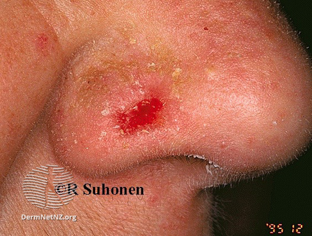 File:Basal cell carcinoma affecting the nose (DermNet NZ lesions-bcc-nose-0646).jpg