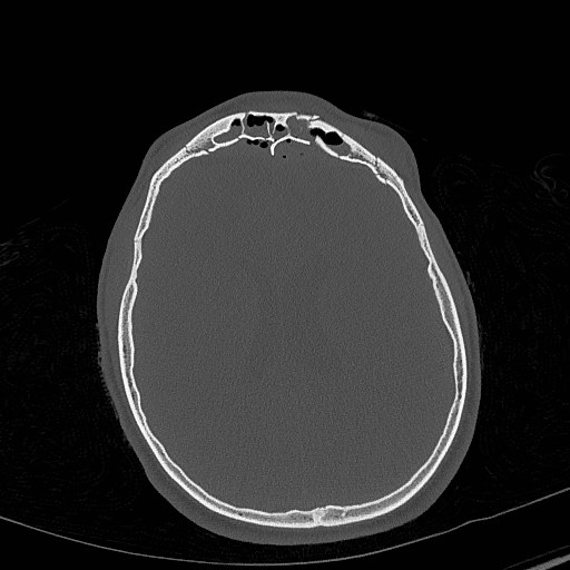 Base of skull fracture with bilateral Le Fort fractures (Radiopaedia 47094-51638 Axial bone window 59).jpg