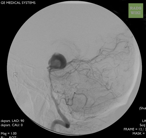 File:Basilar artery aneurysm (Radiopaedia 11533-32156 B 1).jpg